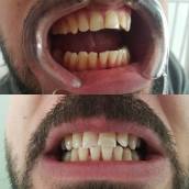 Wybielanie zębów metodą lampa+żel